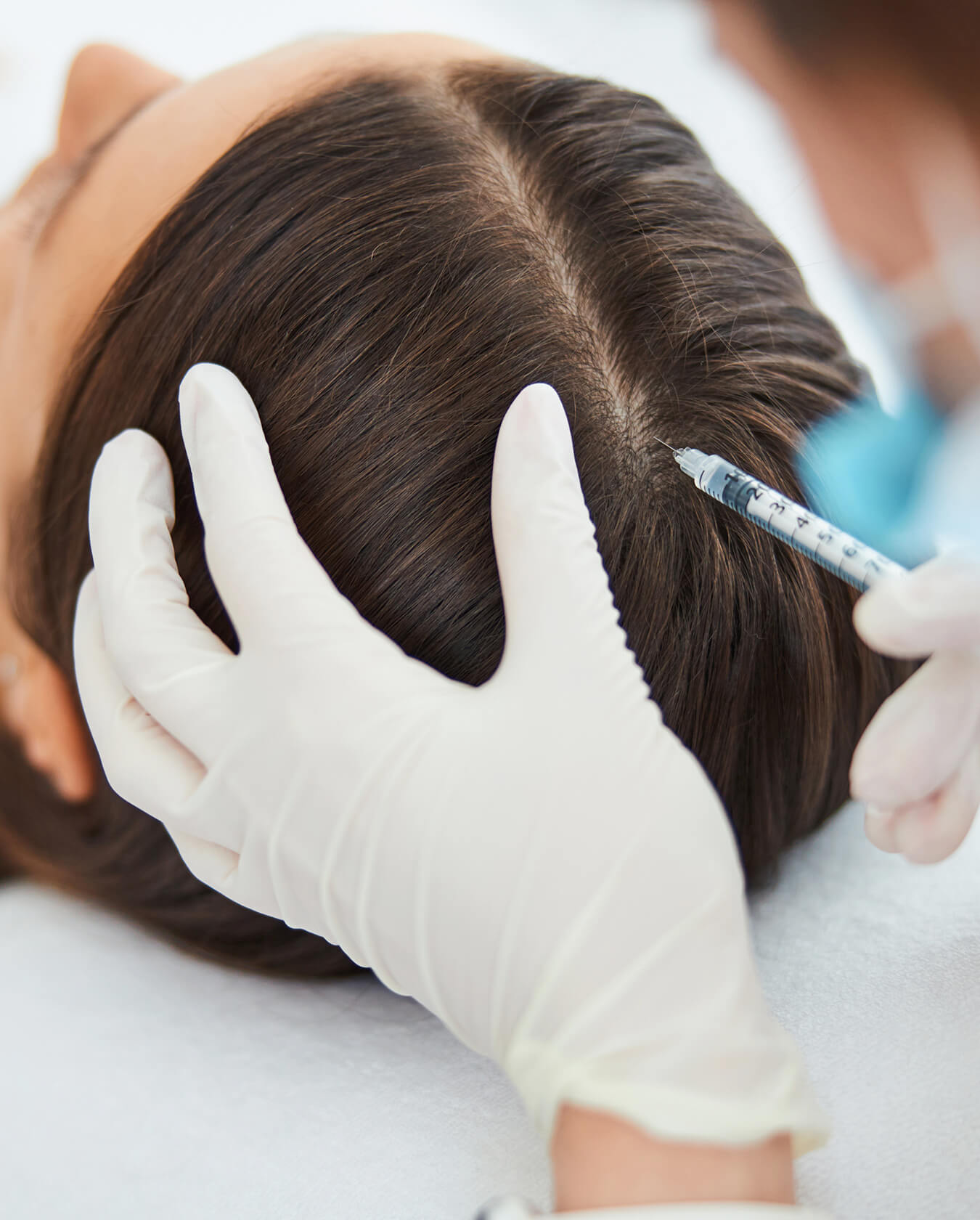 PRP for Hair Loss PRP for Hair Loss
